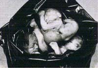 Hysterotomie /7,6kb/25kb (485x339)